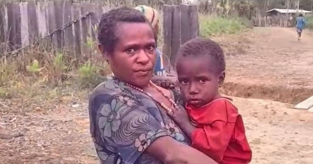 Ilustrasi berita Papua: Wabah Campak di Dogiyai, Papua Tengah Renggut Nyawa 13 Anak-anak