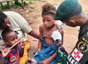 Gadis 9 Tahun Alami Luka Bakar di Wajah, Ini yang Dilakukan Satgas Pamtas Statis RI-PNG Yonif 111/KB